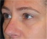 Restylane 