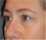 Restylane 