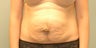 34 Year Old Female Abdominoplasty