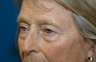 Fat grafting cheeks with ptosis repair and quad bleph