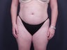 Liposuction Abdomen & Flanks