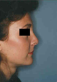 Revision Rhinoplasty