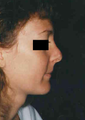 Revision Rhinoplasty