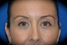 Eyelid Surgery