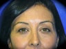 Eyelid Surgery