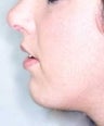 Female patient who underwent a chin implant 