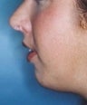 Female patient who underwent a chin implant 