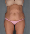 Tummy Tuck