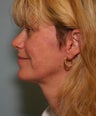 Facelift