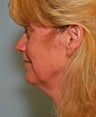Facelift