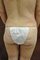 Back liposuction