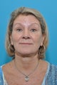 60-year-old female for 1st Botox Treatment