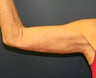 Arm Lift (Brachioplasty)
