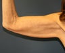 Arm Lift (Brachioplasty)