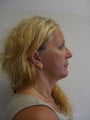 Facelift