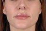 Lip Enlargment