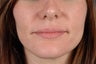 Lip Enlargment