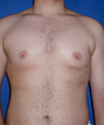 Gynecomastia