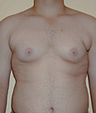 Gynecomastia