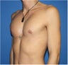 Pectoral Augmentation, Pec Implants