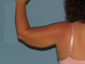 Patient had a Brachioplasty (armlift).