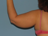 Patient had a Brachioplasty (armlift).