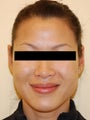 Restylane for Nasolabial Folds