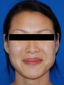 Restylane for Nasolabial Folds