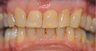 Mature lady says goodbye to horrible crown with the help of Invisalign