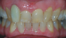 Mature lady says goodbye to horrible crown with the help of Invisalign