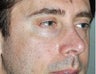 45 Year Old Male Who Desired Stronger Appearing Cheeks