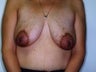 29 year old female patient who underwent a breast augmentation 