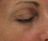 Fraxel re:pair CO2 laser resurfacing for eyes (Nonsurgical Blepharoplasty)