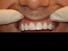 Change Composite to Porcelain Veneers