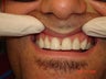 Change Composite to Porcelain Veneers