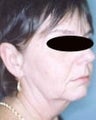 47  year old female patient 