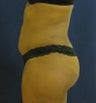 Brazilian Buttock Lift