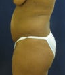 Brazilian Buttock Lift