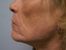 Mixto Laser Resurfacing-Ablative Setting