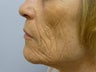 Mixto Laser Resurfacing-Ablative Setting