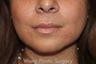 Juvederm