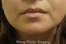 Juvederm