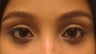 Restylane
