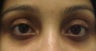 Restylane