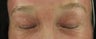 Fraxel re:pair (repair) CO2 laser resurfacing