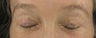 Fraxel re:pair (repair) CO2 laser resurfacing