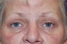 Endoscopic Brow Lift