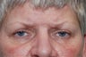 Endoscopic Brow Lift