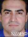 Male Primary Rhinoplasty 