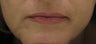 Fraxel re:pair (repair) for lip lines and lip enhancement